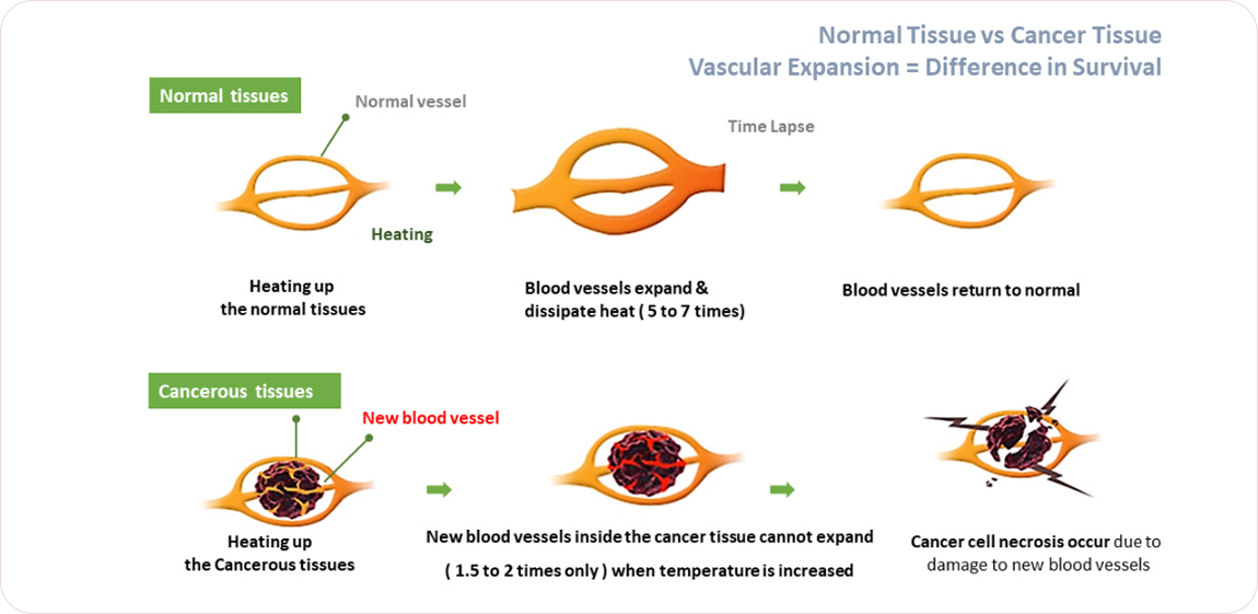 Effects of Heat Treatment Using Miracle 1C Hyperthermia